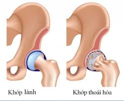 Triệu chứng và cách chẩn đoán thoái hóa khớp háng xquang 