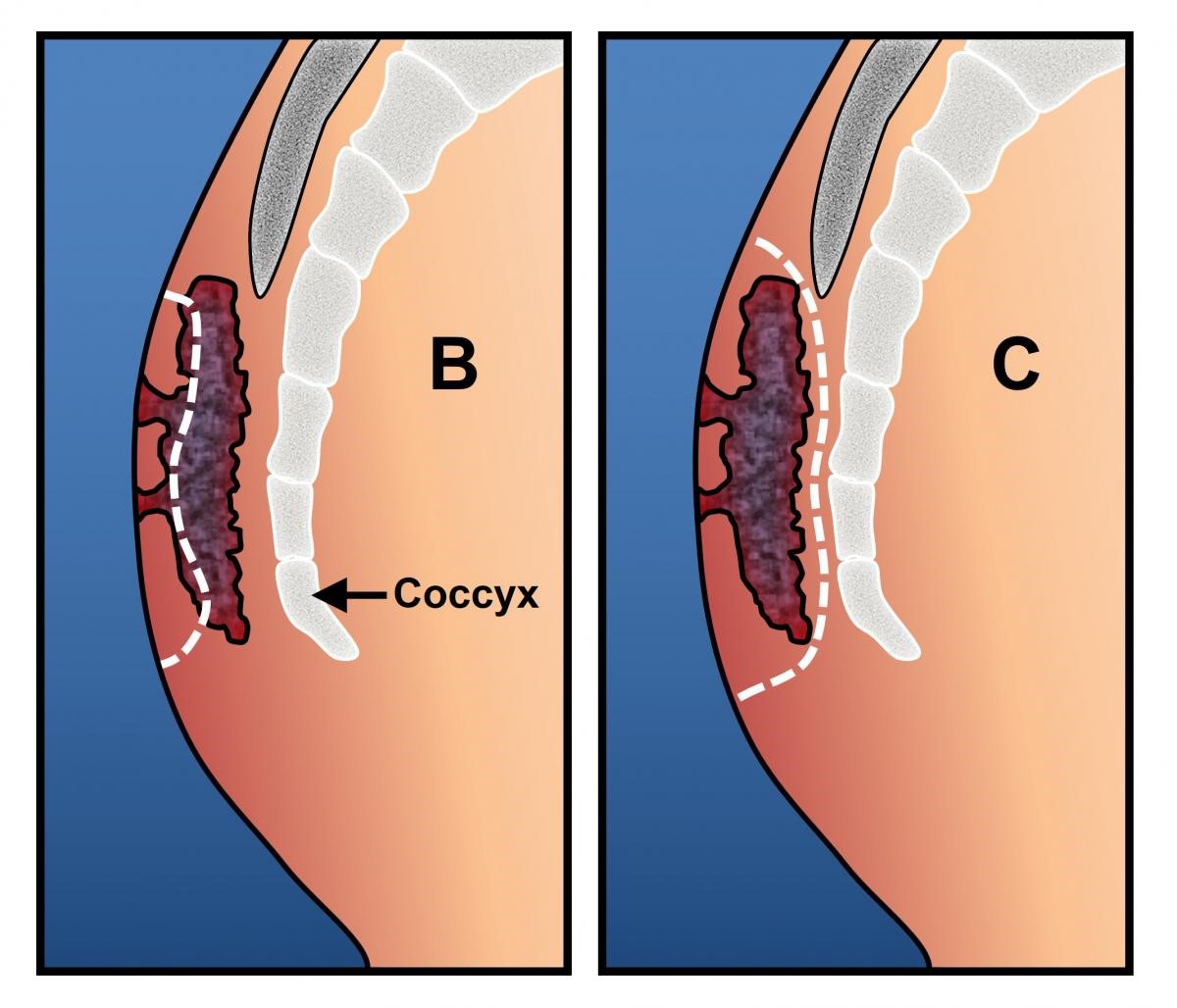 Đau vùng mông gần xương cụt có thể lan sang những vùng khác của cơ thể không?