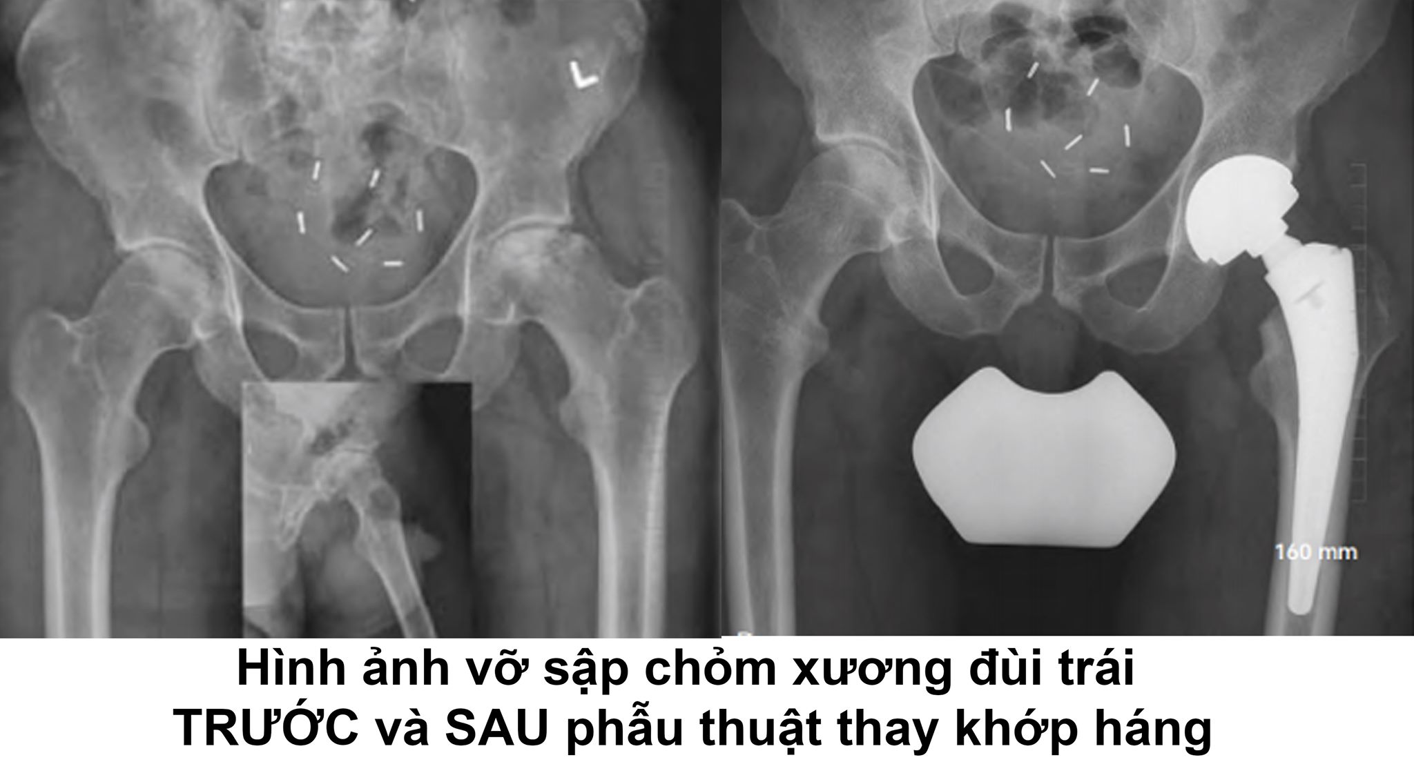 Có những biện pháp phòng ngừa hoại tử khớp háng nào có thể được thực hiện?
